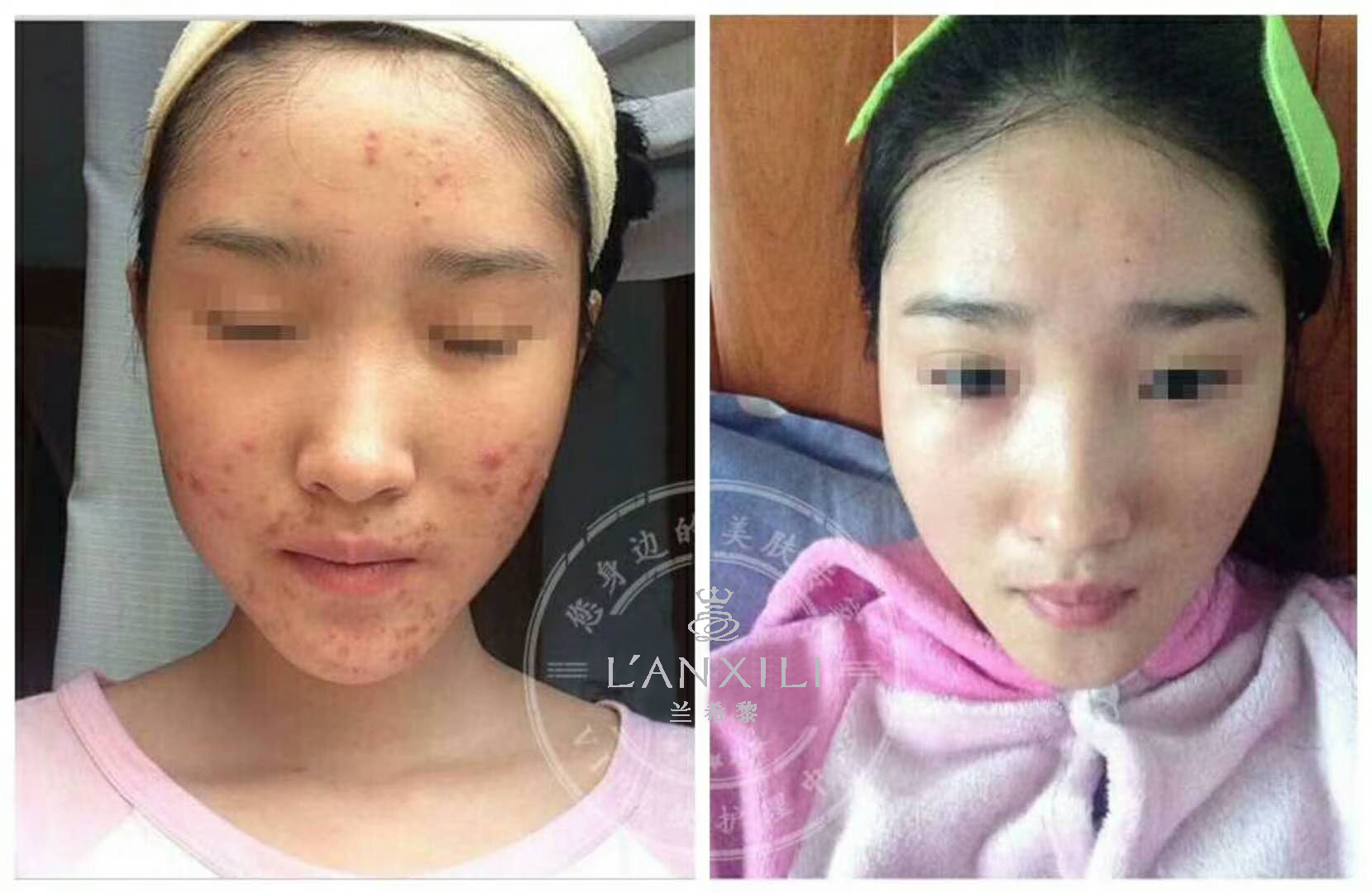 夏天痘痘祛斑全部爆发！！我这有妙招，教你如何轻松解决