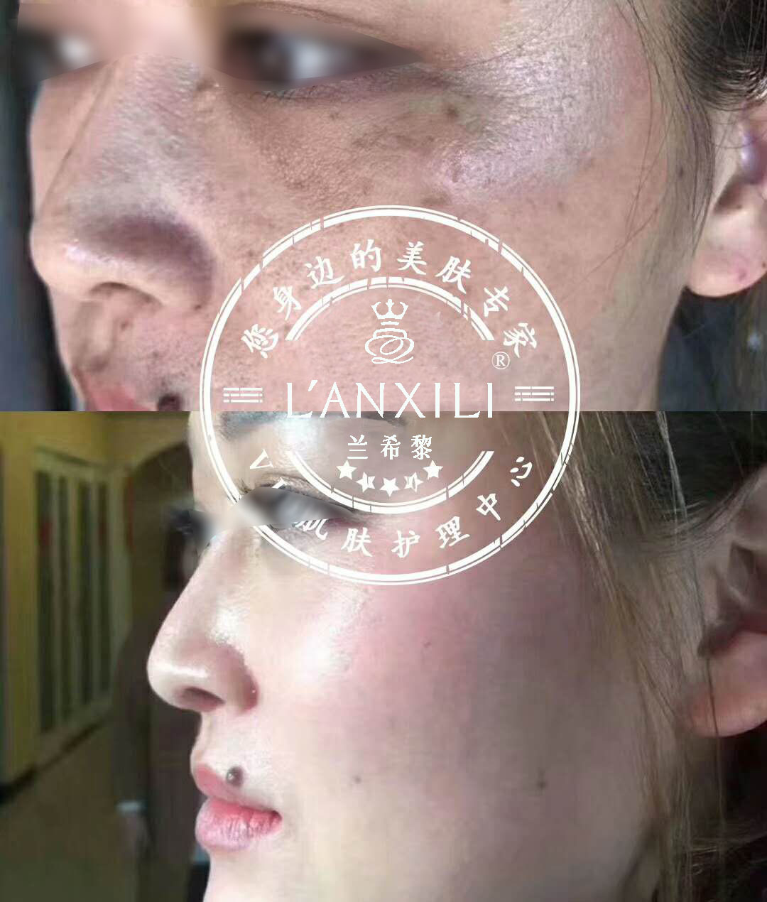 夏天痘痘祛斑全部爆发！！我这有妙招，教你如何轻松解决