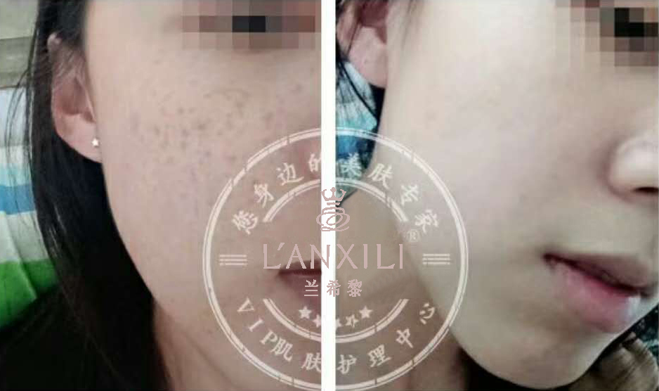 夏天痘痘祛斑全部爆发！！我这有妙招，教你如何轻松解决