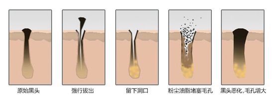 怎么才可以“告别”黑头呢？